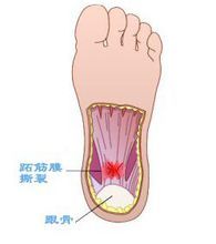 怎么预防和认识肌筋膜炎?