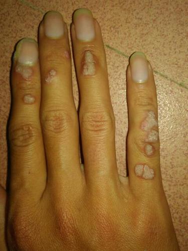 请问我手上长那么多这种鱼鳞痣该怎么治疗