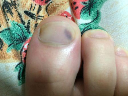 脚指甲上出现一块青紫色的疤是什么啊?好吓人,如图,求医生帮忙看看.