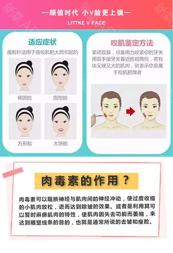 【除皱瘦脸】衡力 除皱瘦脸 50单位 ,【除皱瘦脸】除皱瘦脸颏肌放松
