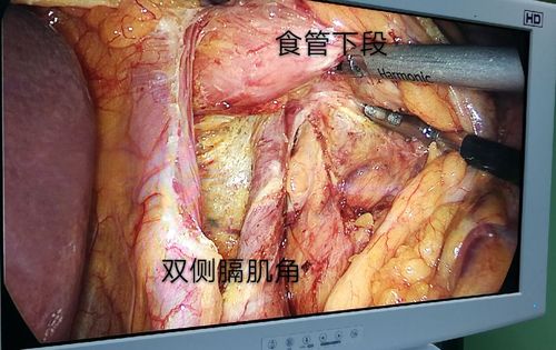 解剖清晰,完整暴露食管下段,膈肌角.