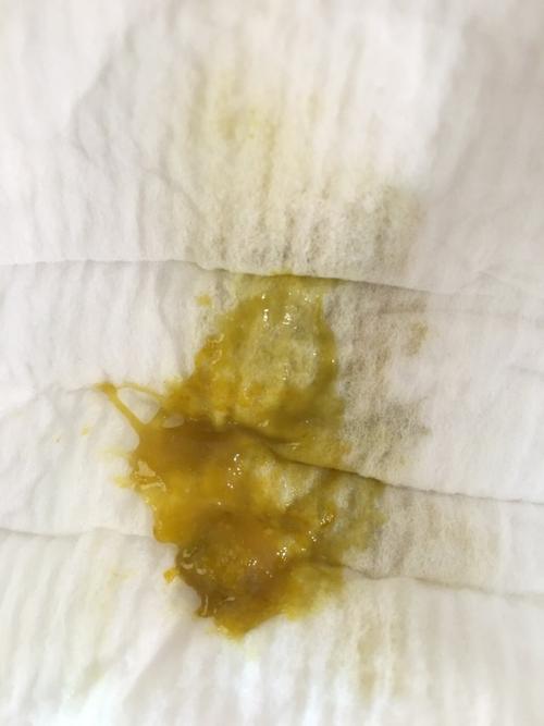 宝宝五个月,种植了轮状病毒疫苗,拉肚子第六天的大便,请问这是慢慢