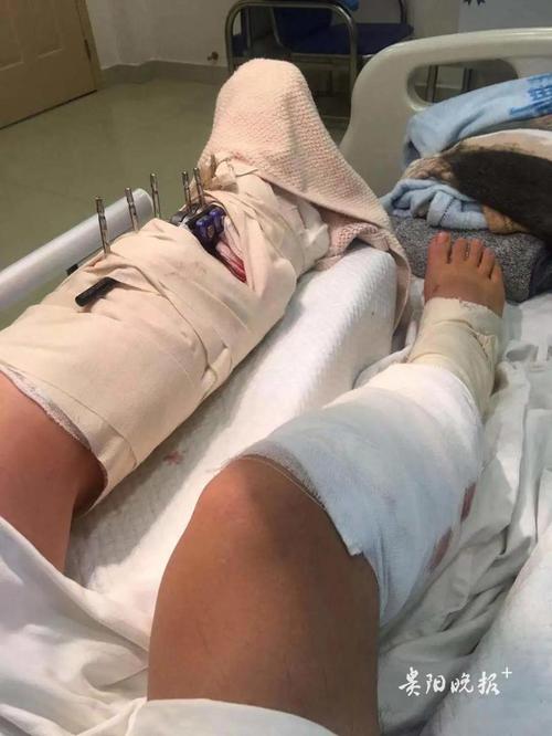 小腿,左小腿,贵州华夏骨科医院,医生,外科