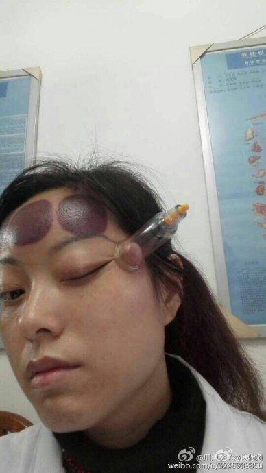 121,问:为什么脑门拔罐痧色深,太阳穴则痧色浅?