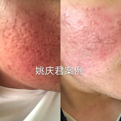 严重痘坑一期治疗