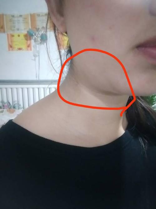 请问我这是甲状腺肿大吗?跟甲亢有关吗?