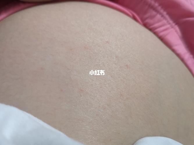 肚子突然长红点点不痒不痛 也不知道什么原因 百度有些说是妊娠纹前兆