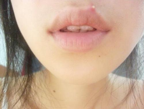 为什么唇部会长痘痘?有什么方法可以治理
