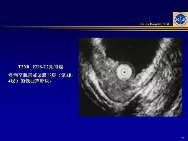 看了这篇晋级胃癌ct诊断高手