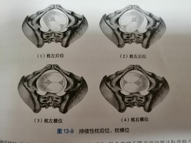 因枕骨持续位于骨盆后方压迫直肠,产妇自