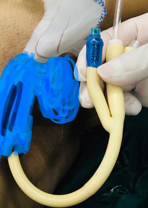 复通!骑跨伤尿道狭窄,男人之痛.