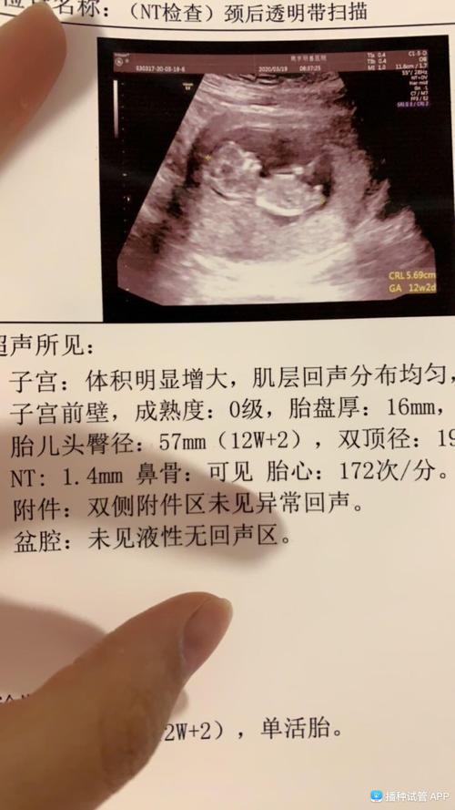 [试管婴儿]有会看男宝女宝的嘛～12周nt