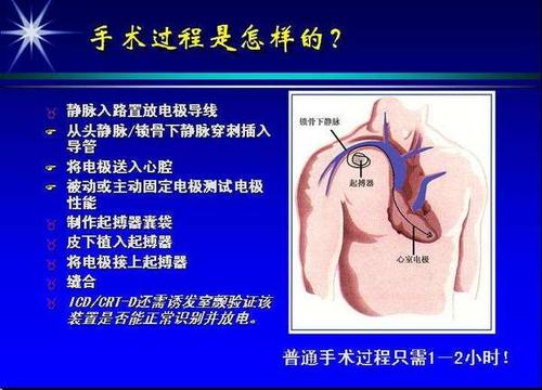 心脏起搏器要花多少钱?怎样装?