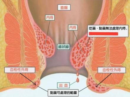 内,外痔横切面图