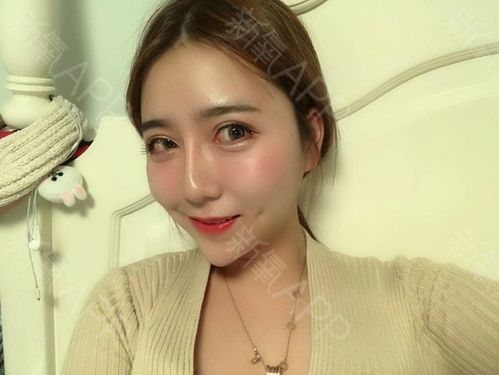 单侧埋线酒窝术后2天,唐为东医生手术的.
