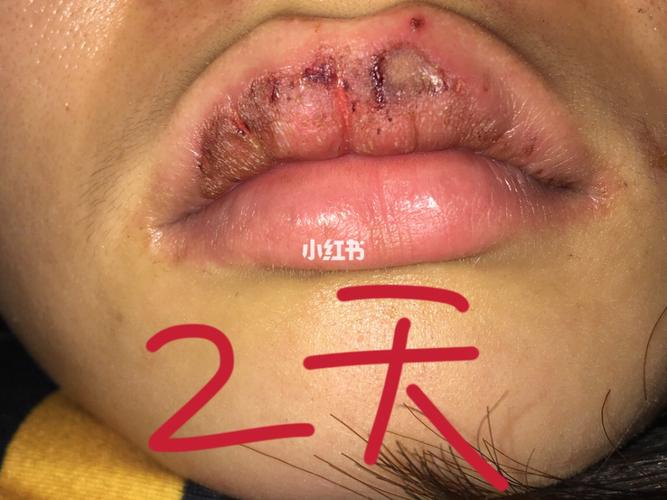 图一是皮脂腺异位