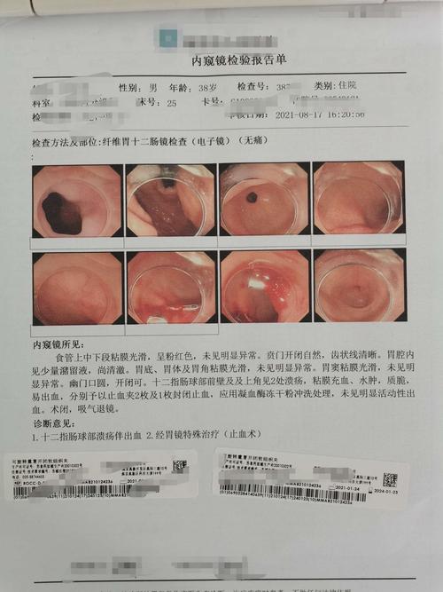 十二指肠溃疡出血并内镜下成功止血一例