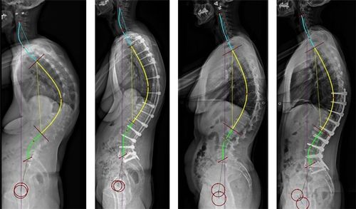 1型脊柱因腰椎前凸小而短,胸椎后凸较长,在退变历程中倾向于出现整体