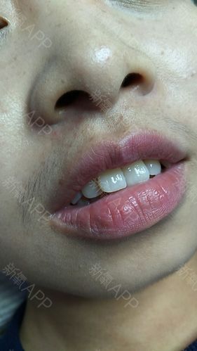 今天是本宝宝第三次脱唇毛了