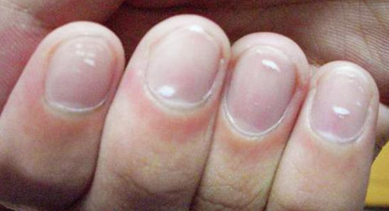 指甲上的白点是怎么一回事 指甲上的疾病