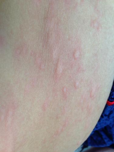 问:身上痒的地方一抓就起疙瘩.是不是过敏.昨天也这样,很快就落了.