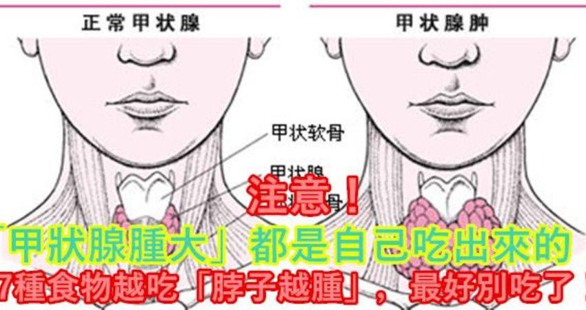 「甲状腺肿大」都是自己吃出来的!7种食物越吃