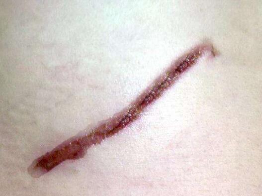 女子腹部有刀疤撒谎"阑尾炎"未婚夫知真相暴怒解除婚约