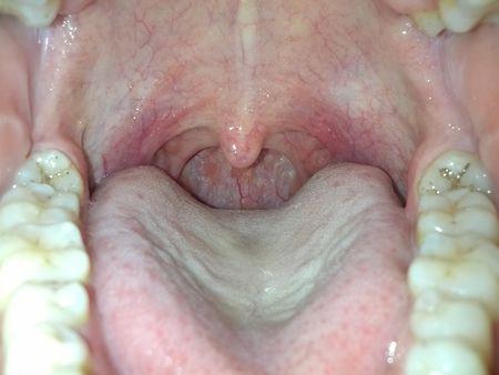 问:嗓子长期带红血丝,干咳,但是咳嗽不厉害,总感觉气管上半部分痒痒的