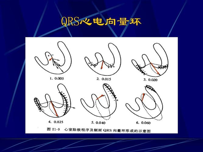 qrs心电向量环