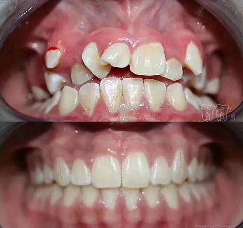 矫正牙齿不齐=终生提高颜值,再犹豫就来不及了!