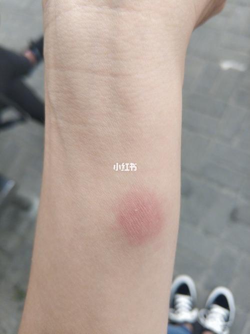 肺结核皮试第一周 虽然之前医生说了,没有被感染 但