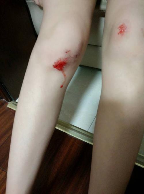 女,16前两天膝盖摔伤了,擦了两天药之后发现有黄色的东西,是不是脓