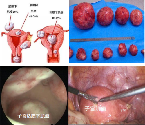 子宫肌瘤