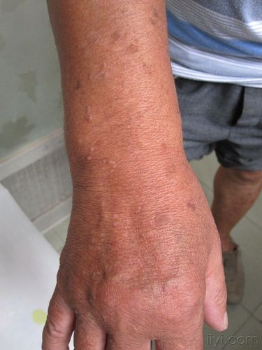 疣状肢端角化病