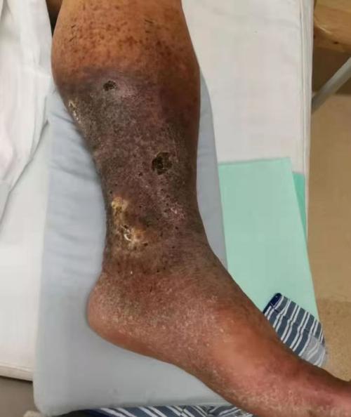 腿肿成"萝卜"还发黑溃烂,以为是皮肤病,真相却是.