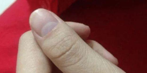 手上若有这3个现象可能是尿酸高了若做好3件事或能改善尿酸