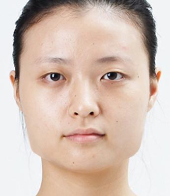 四方脸整形术手术方法