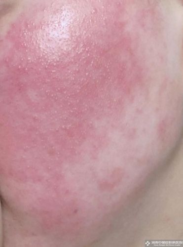 皮肤过敏又红又痒怎么办