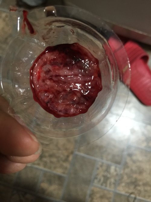 这是流产了吗,有图慎入