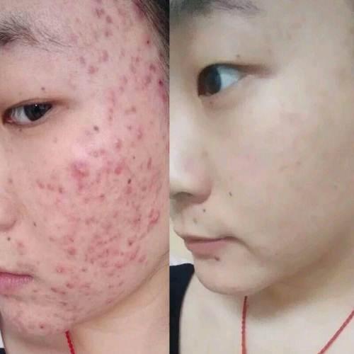 祛痘珍珠膏,去痘痘痘印,痘坑痘疤,红血丝闭口