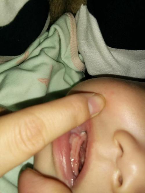 我儿子嘴里牙龈侧面长了白色的小东西,大家有过这种情况吗?