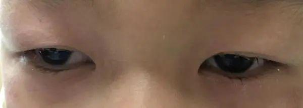 痒到女孩连眼睫毛都拔光,还不是这个病惹的祸?
