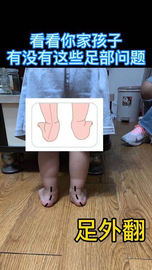 什么是足外翻?儿童常见的一种足部问题