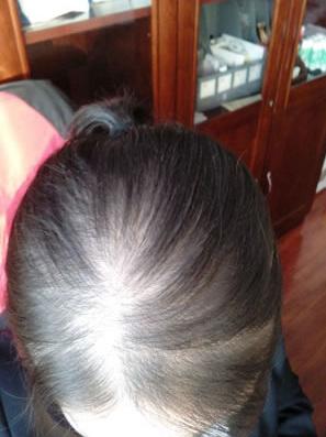 原创产后脱发一年,终于不掉了头发新张又黑又亮