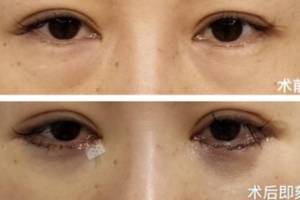 眼袋手术后遗症有哪些 切眼袋术后注意事项是什么 求实锤