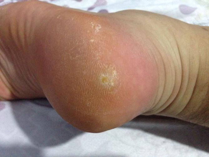 后脚跟长一个包,用手摸起来硬硬的,一点也不痒,稍稍用力按会痛,走路