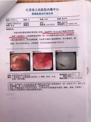 而在人民医院的胃镜检查报告上是异物横贯食管腔,两端刺入粘膜.