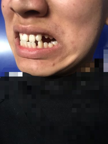 我想问一下 像这样的牙齿当兵体检无论什么兵种有能体检通过的兵种么