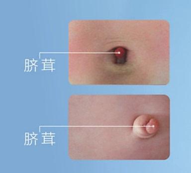 另外,如果孩子的肚脐上出现一个樱桃一样,鲜红色的肿块儿,就像图上