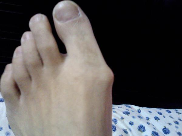 问脚上长了一个瘤,有图